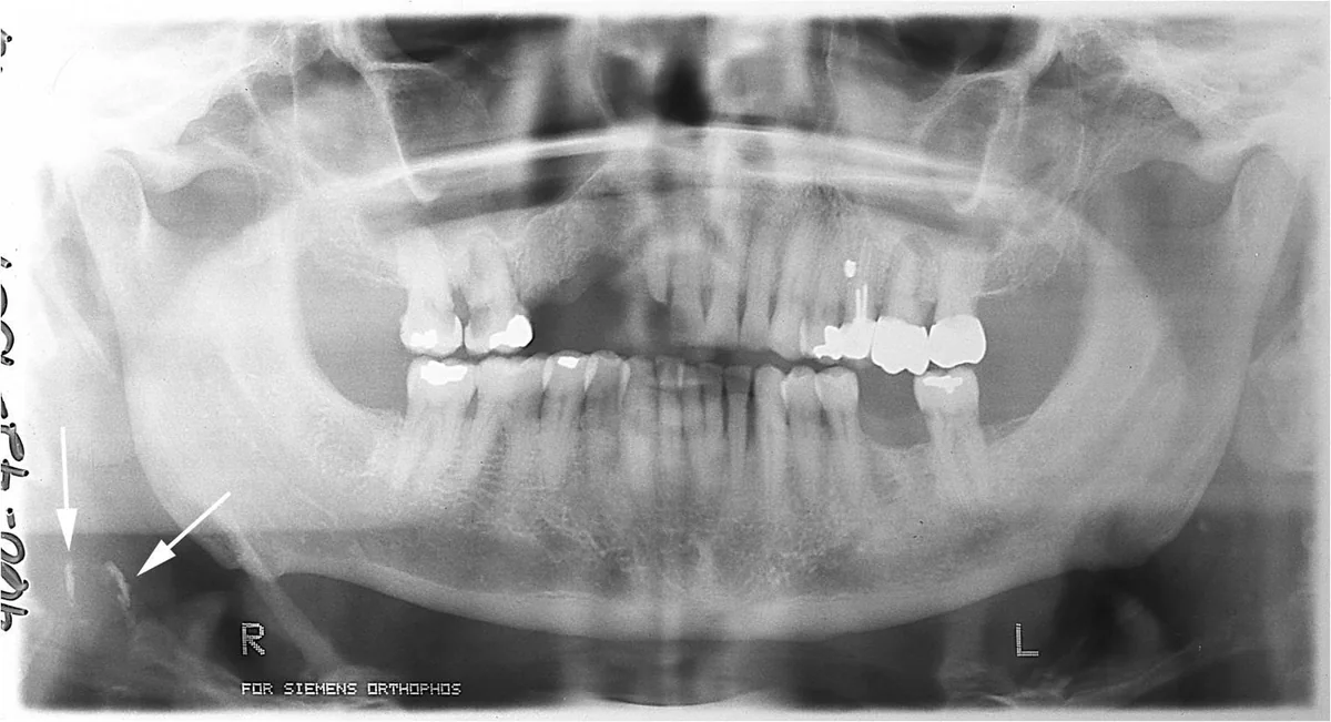An example panoramic dental radiograph showing the upper and lower jaws and teeth.